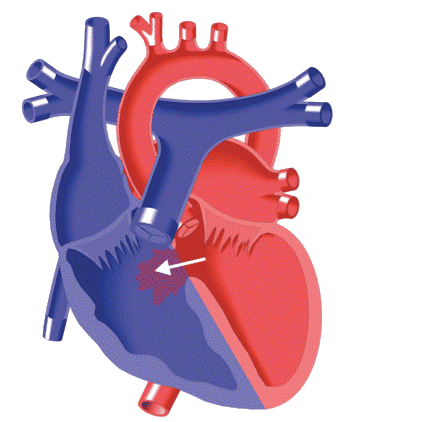 سوراخ قلب نوازد کی بسته می شود؟
