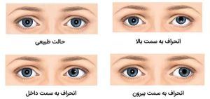 استرابیسم یا انحراف چشم (لوچی)کیدز 24