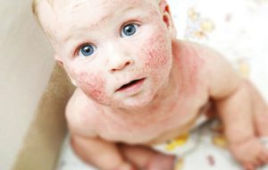 آلرژی به گندم در کودکان کیدز 24